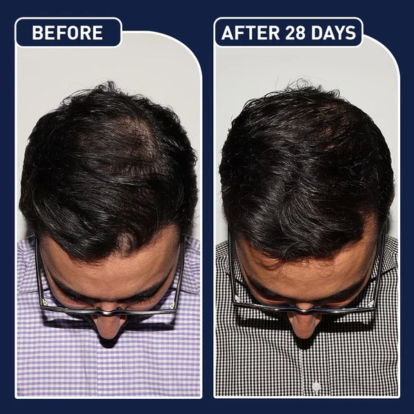 🎁Today's Offer: 65% off on FEG™ Hair Growth Spray
