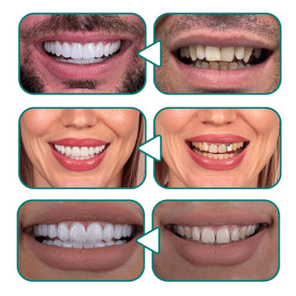 Snap - On Smile ابتسامة مثالية في ثوانٍ