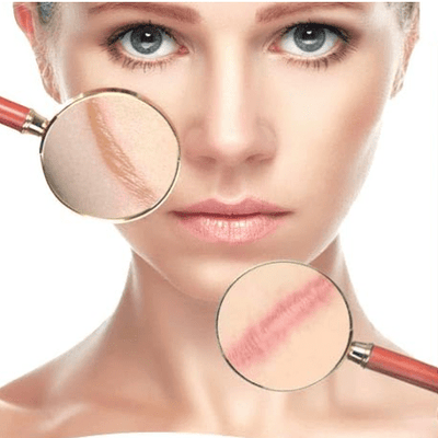 Aichun Beauty - جل إزالة الندوب