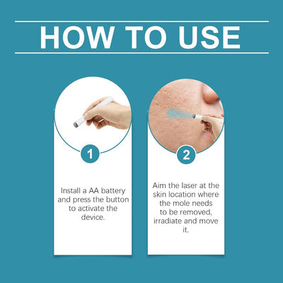 Xorita Non - Invasive Mole and Wart Removal Pen